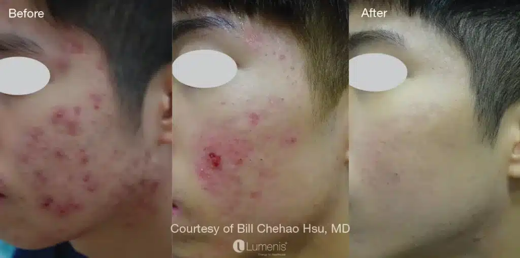 Before & After Image of Acne Treatment | Noble Clinic in Draper, Utah