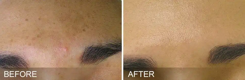 Before and After Brown Spots treatment | Noble Clinic in Draper, Utah