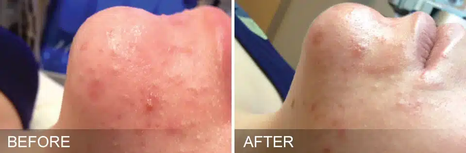 Before and After Oily Congested treatment | Noble Clinic in Draper, Utah