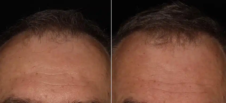 Keravive treatment Before and After | Noble Clinic in Draper, Utah