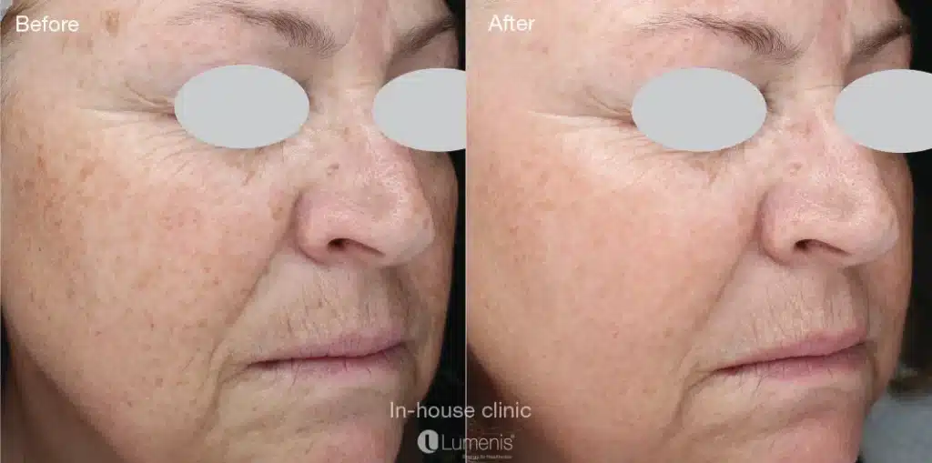 Before & After Image of Facial Toning & Photofacial | Noble Clinic in Draper, Utah