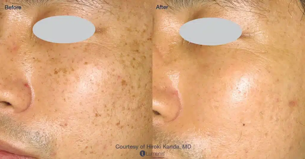 Before and After Photo rejuvenation treatment | Noble Clinic in Draper, Utah