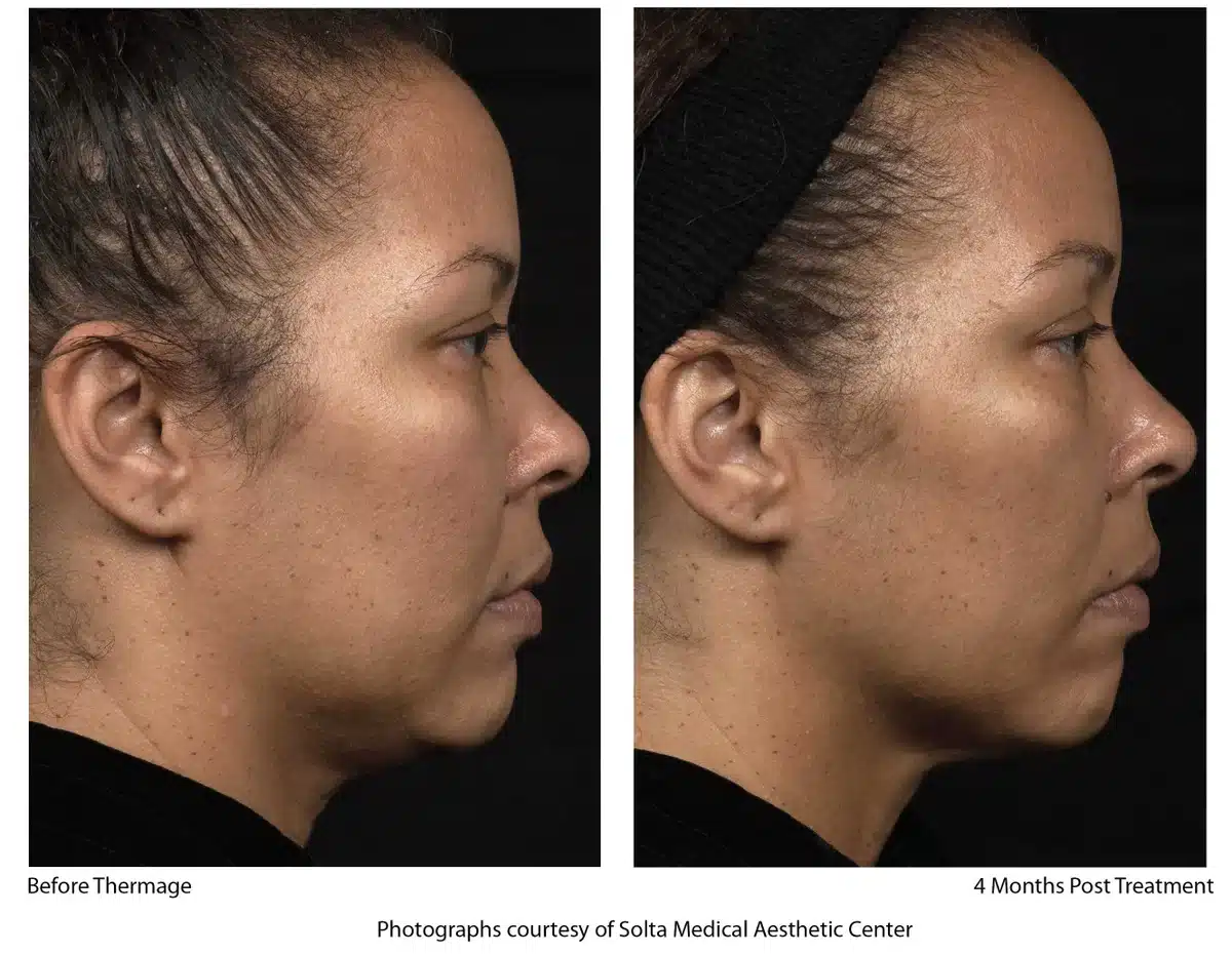 Thermage treatment Before and After | Noble Clinic in Draper, Utah