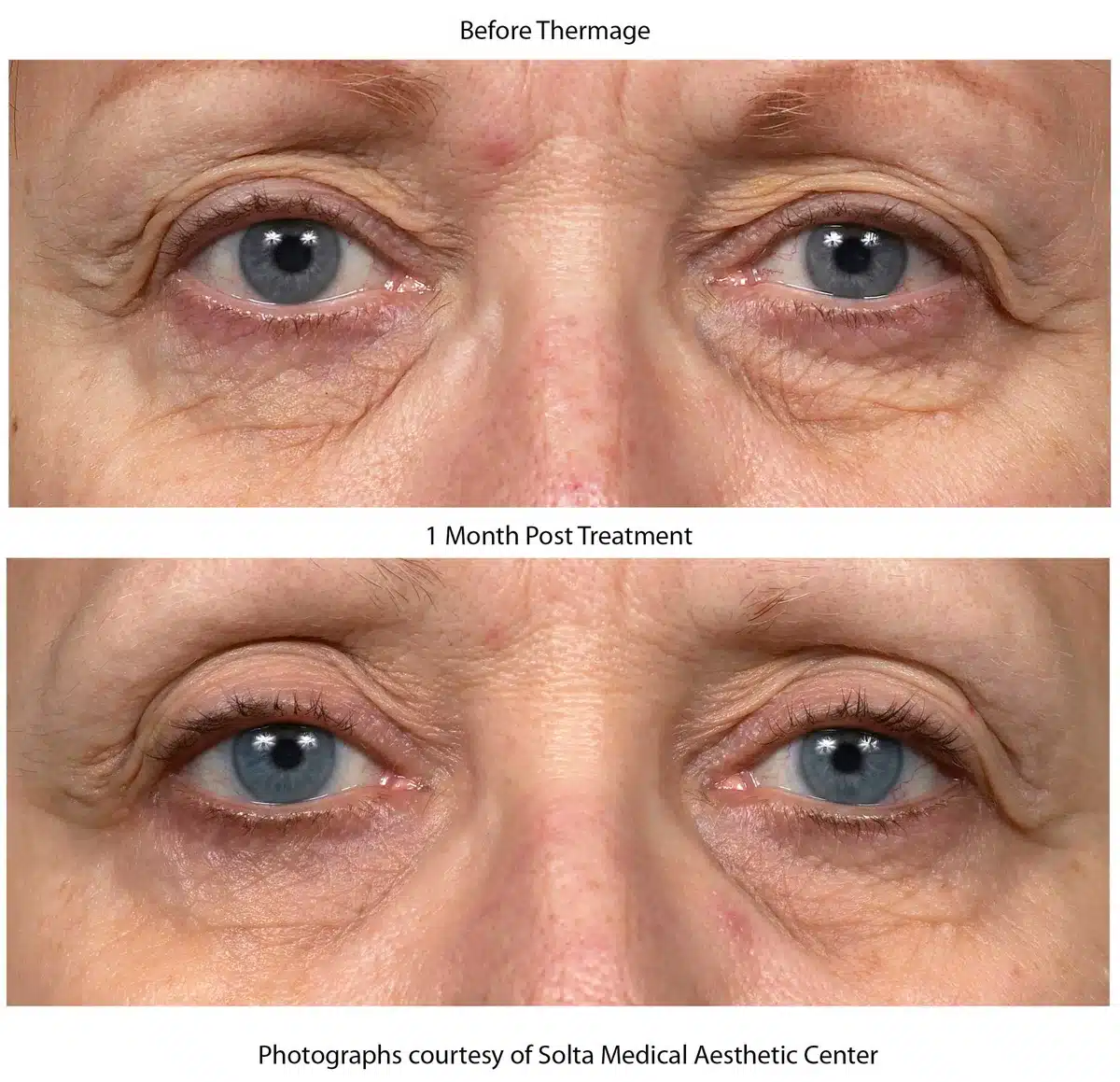 Thermage treatment Before and After | Noble Clinic in Draper, Utah