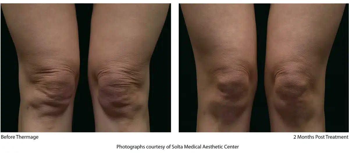 Thermage treatment Before and After | Noble Clinic in Draper, Utah