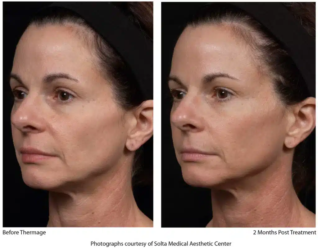Thermage treatment Before and After | Noble Clinic in Draper, Utah