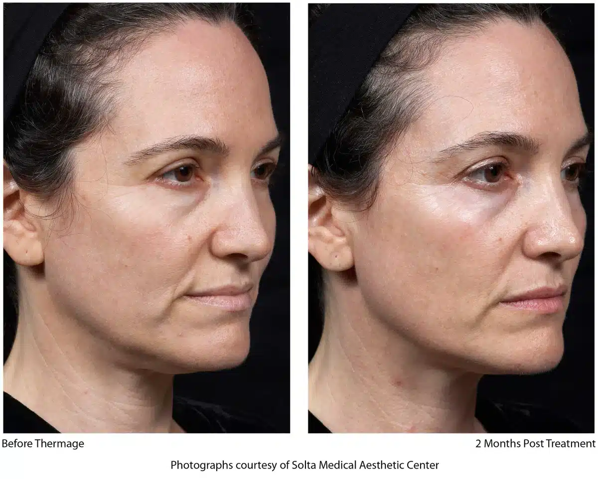 Thermage treatment Before and After | Noble Clinic in Draper, Utah