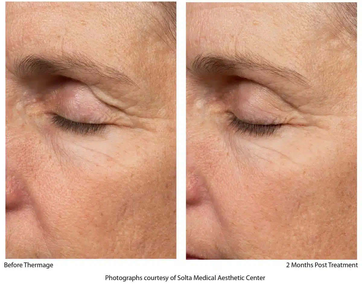 Thermage treatment Before and After | Noble Clinic in Draper, Utah