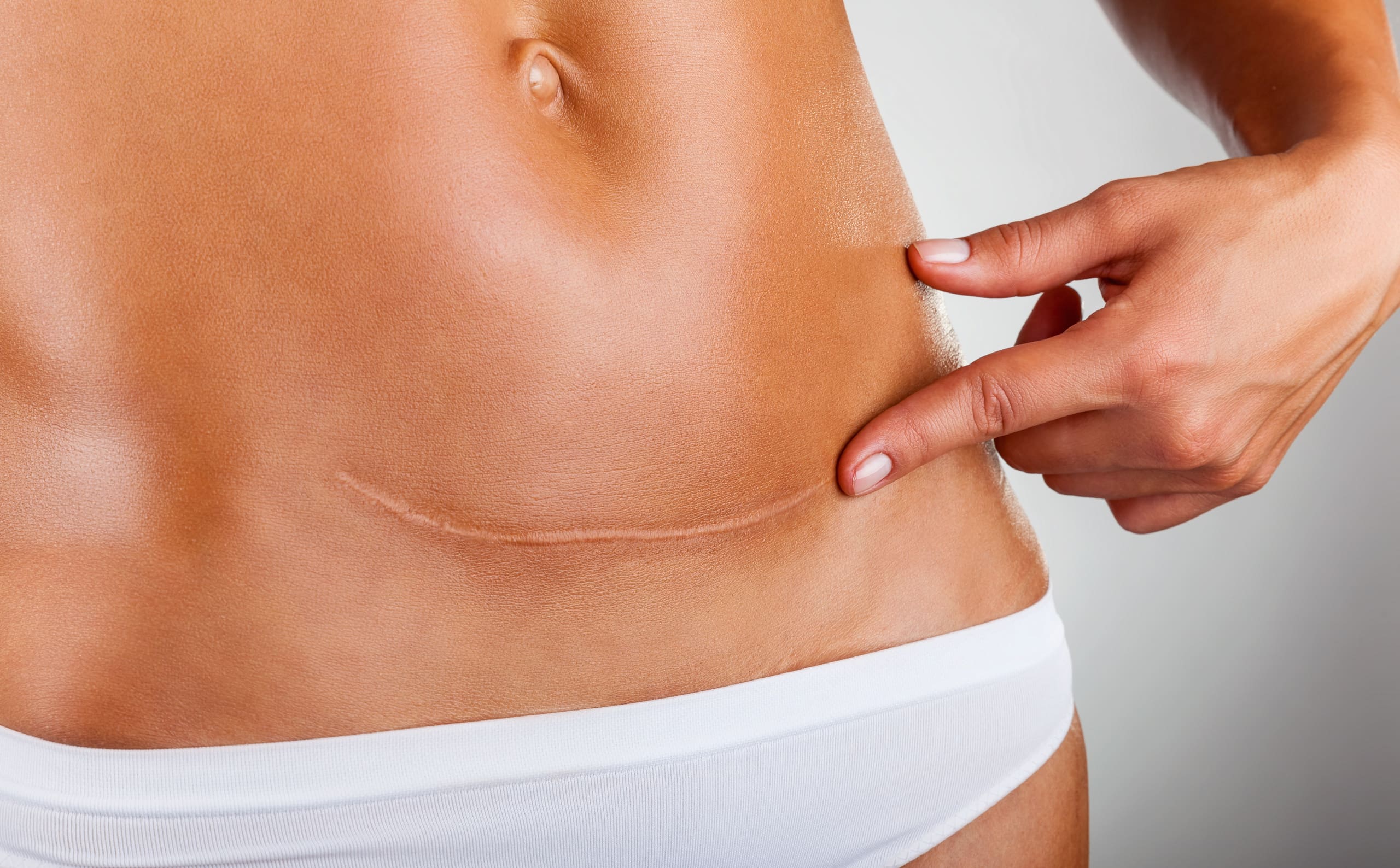 Woman Pointing Stretch Mark on her Stomach | Noble Clinic in Draper, UT