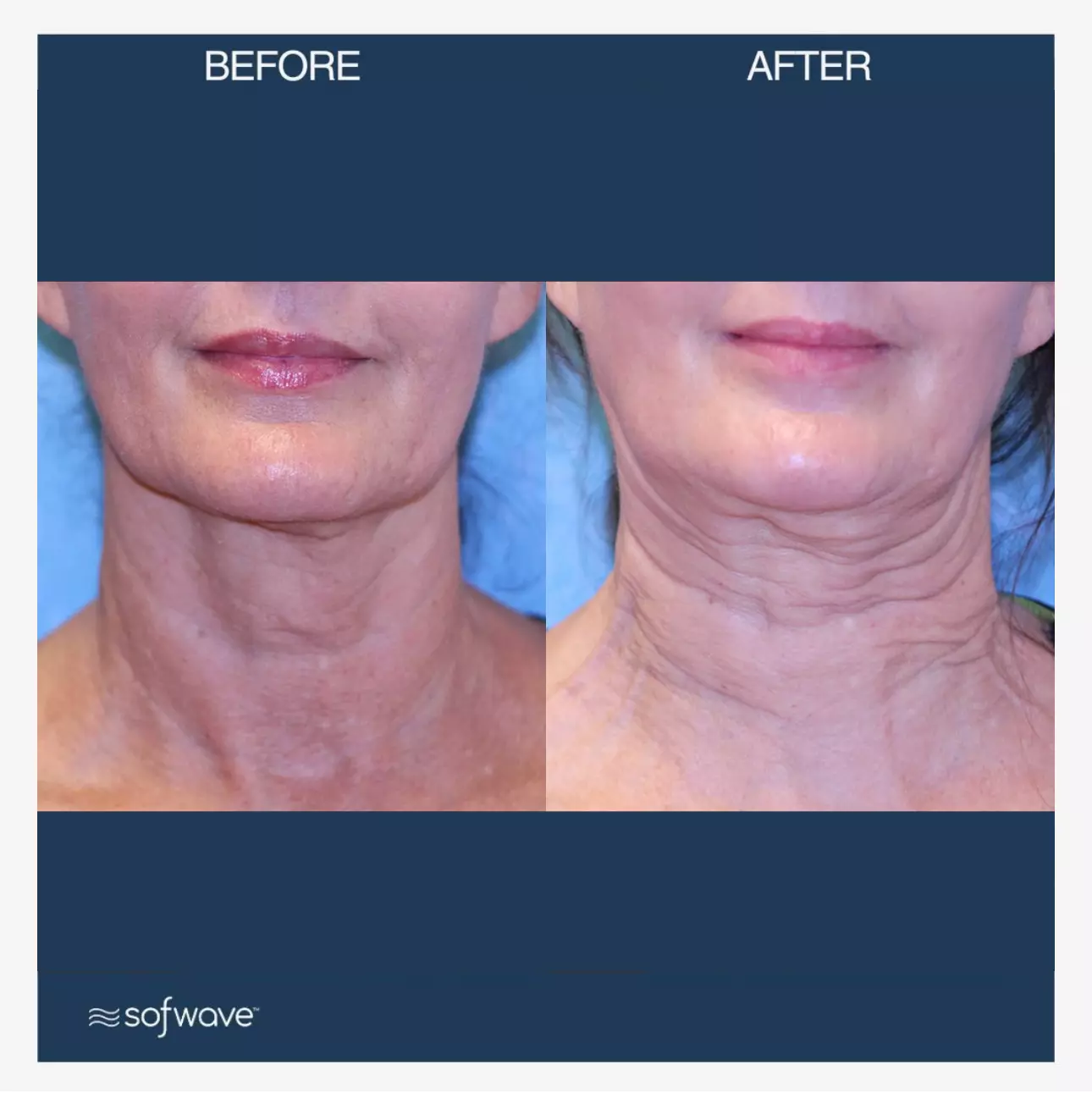 Sofwave™ Before and After in Draper, Utah | Noble Clinic