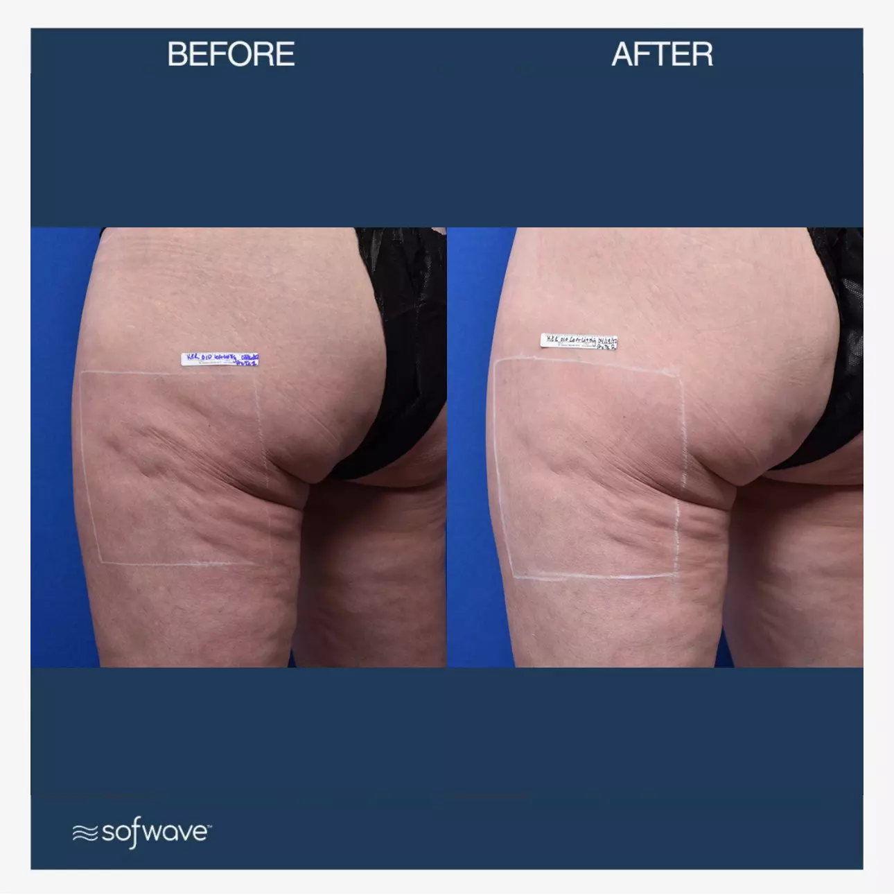 Sofwave™ in Draper, Utah | Noble Clinic