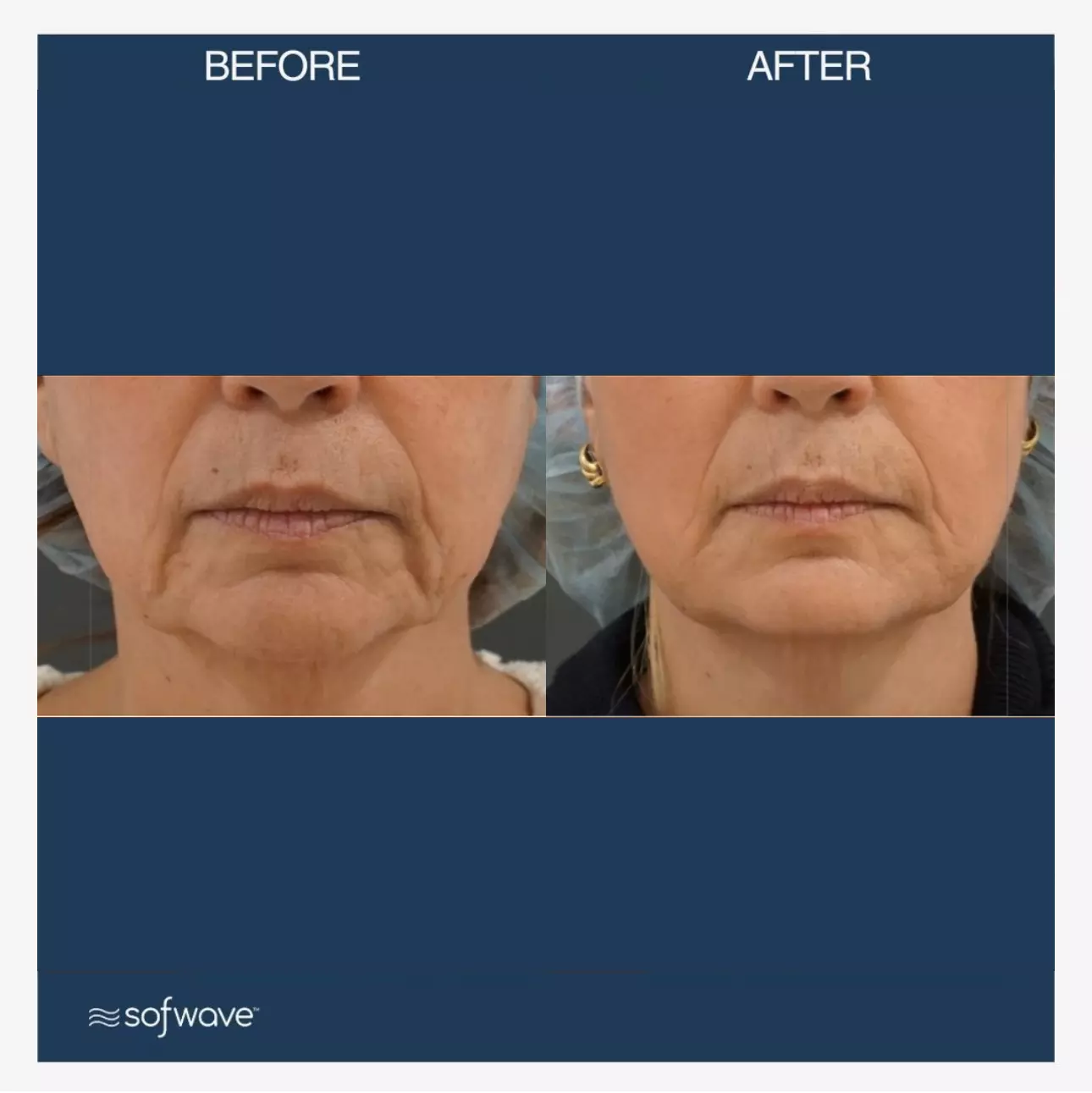 Sofwave™ | Noble Clinic in Draper, Utah