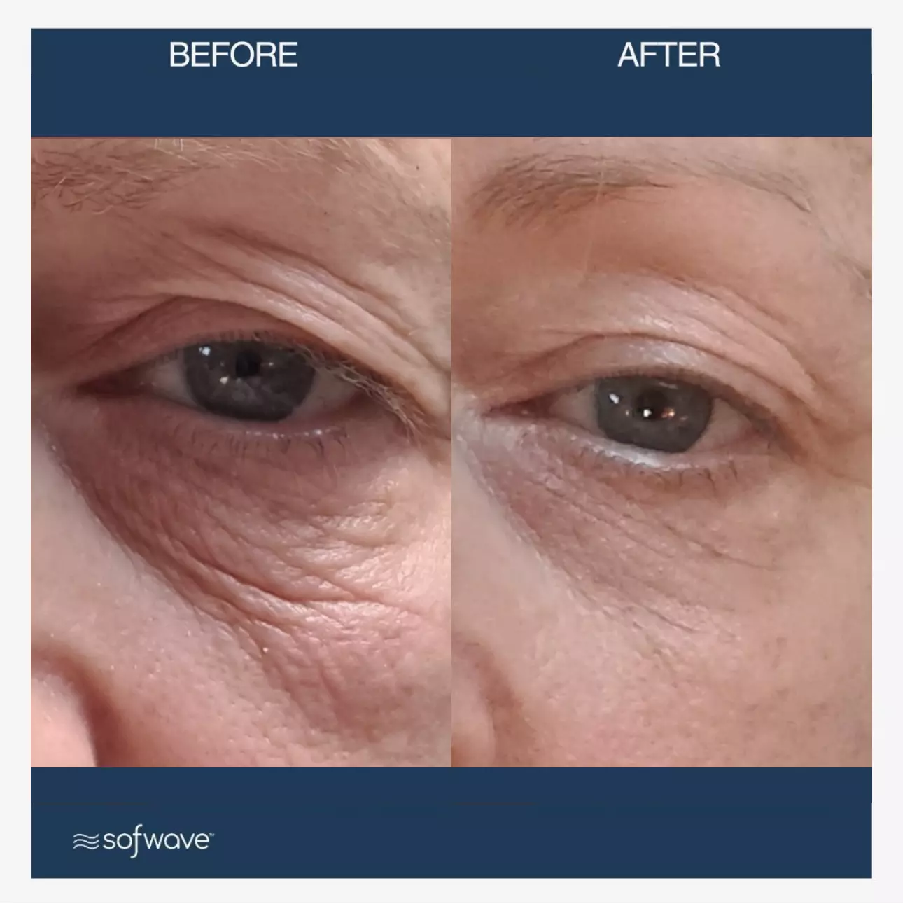 Sofwave™ | Noble Clinic in Draper, Utah