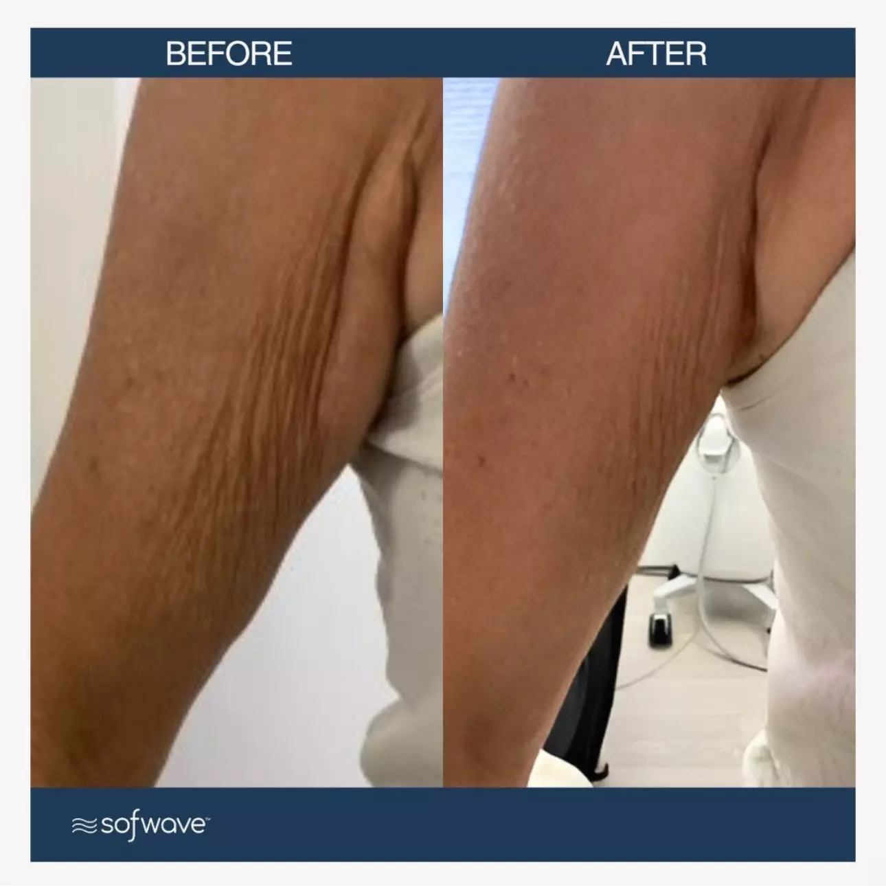 Sofwave™ Before and After by Noble Clinic in Draper, Utah