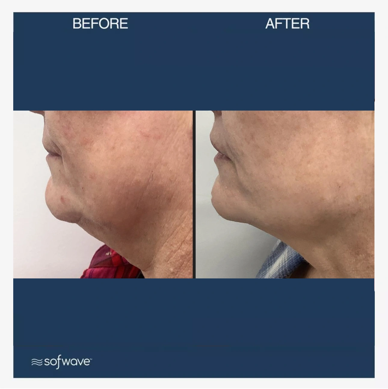 sofwave thenobleclinic before and after bb