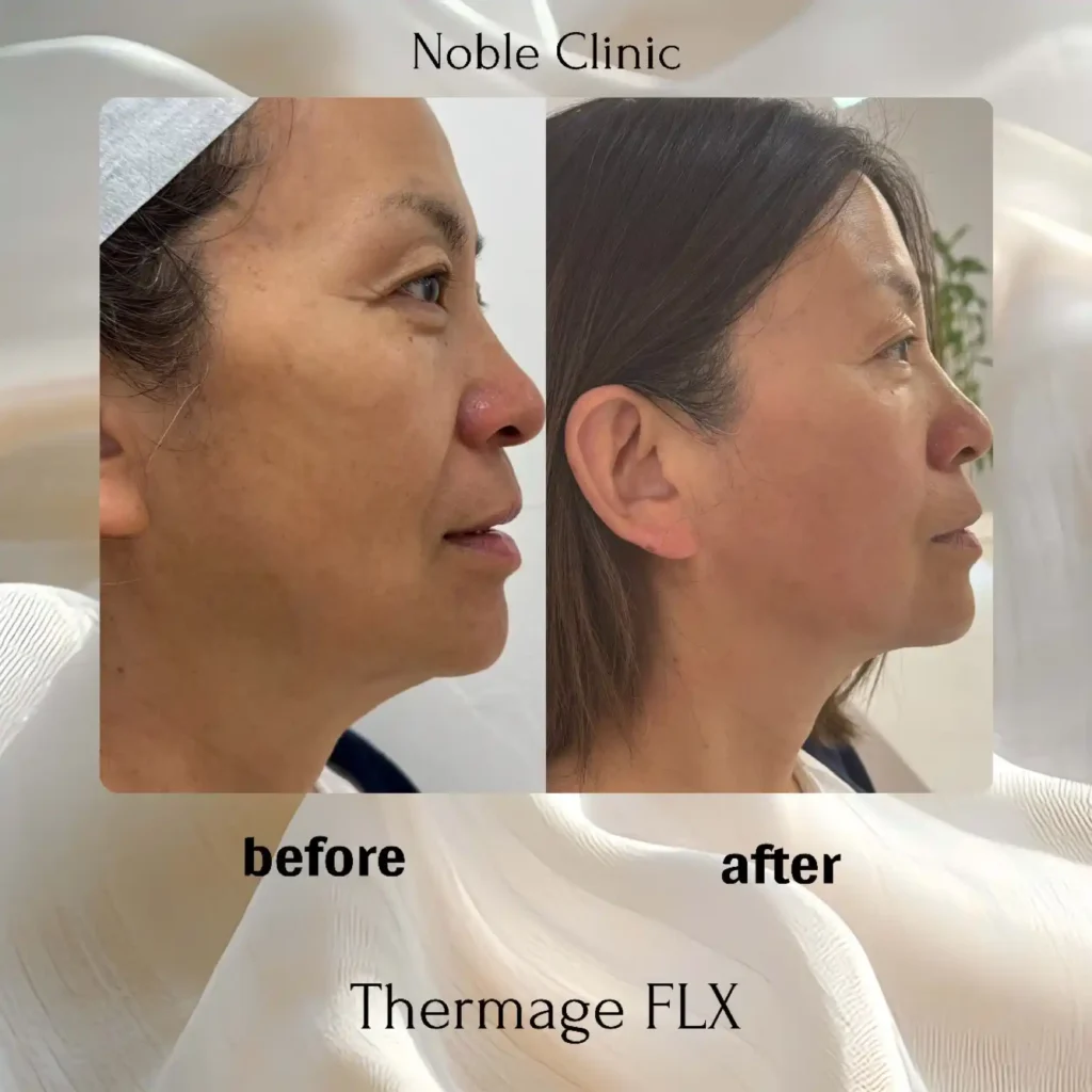 Thermage FLX Before and After in Draper, Utah | Noble Clinic