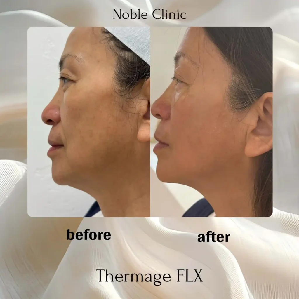 Thermage FLX in Draper, Utah | Noble Clinic