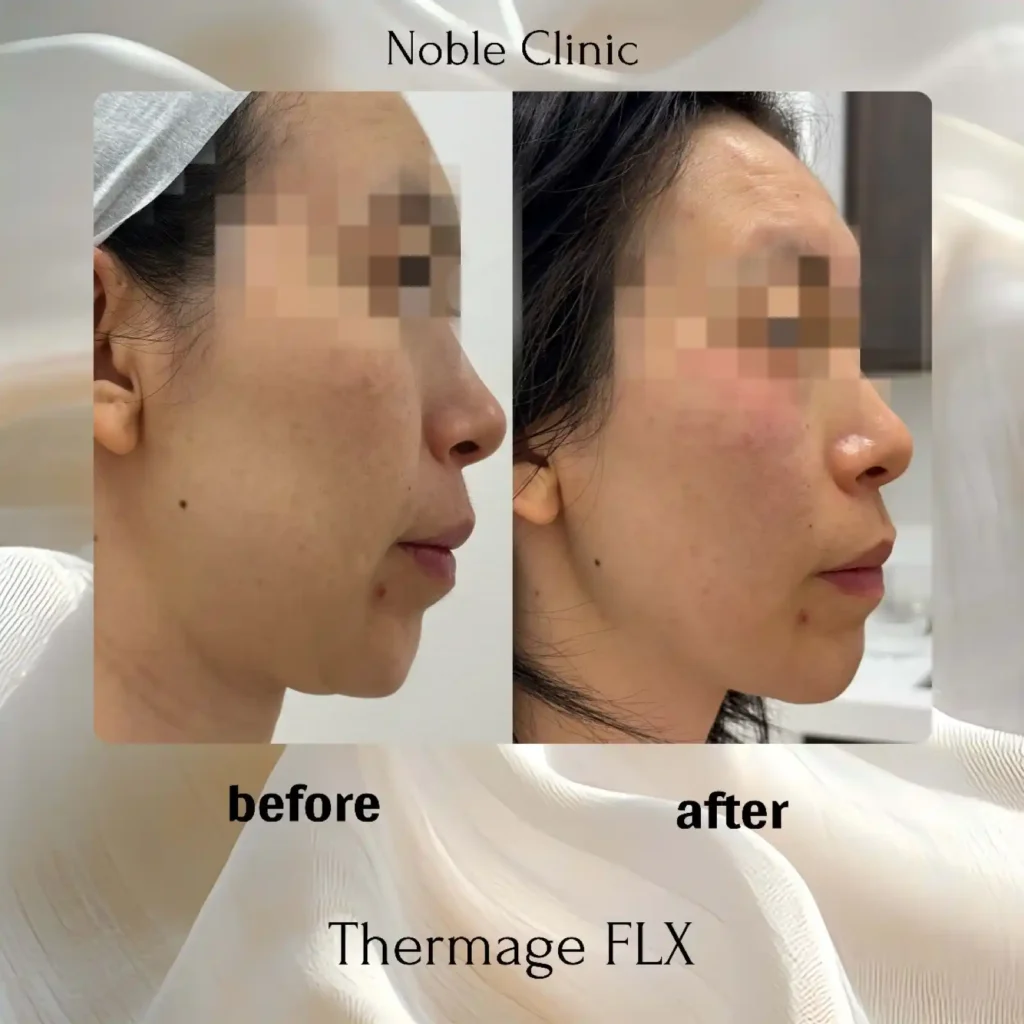 Thermage FLX Before and after in Draper, Utah | Noble Clinic
