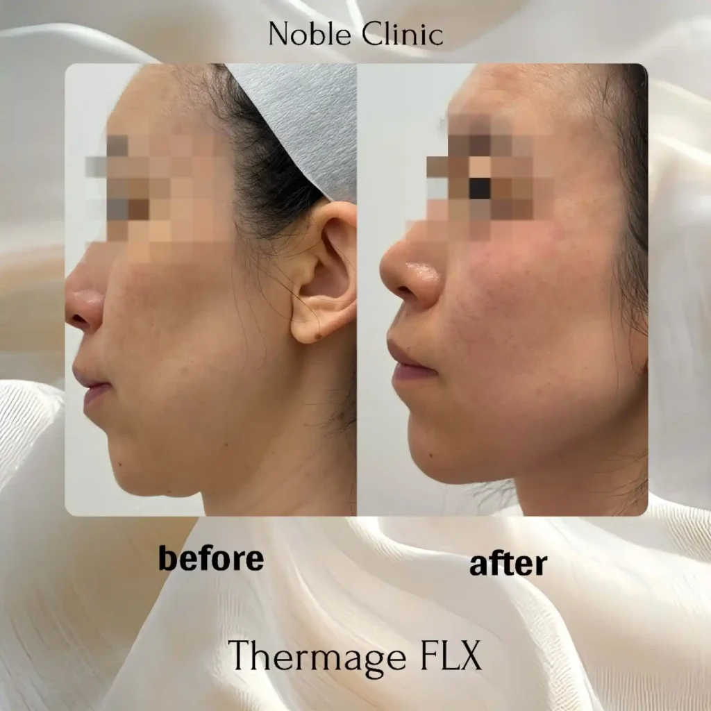 Thermage FLX Before and after in Draper, Utah | Noble Clinic