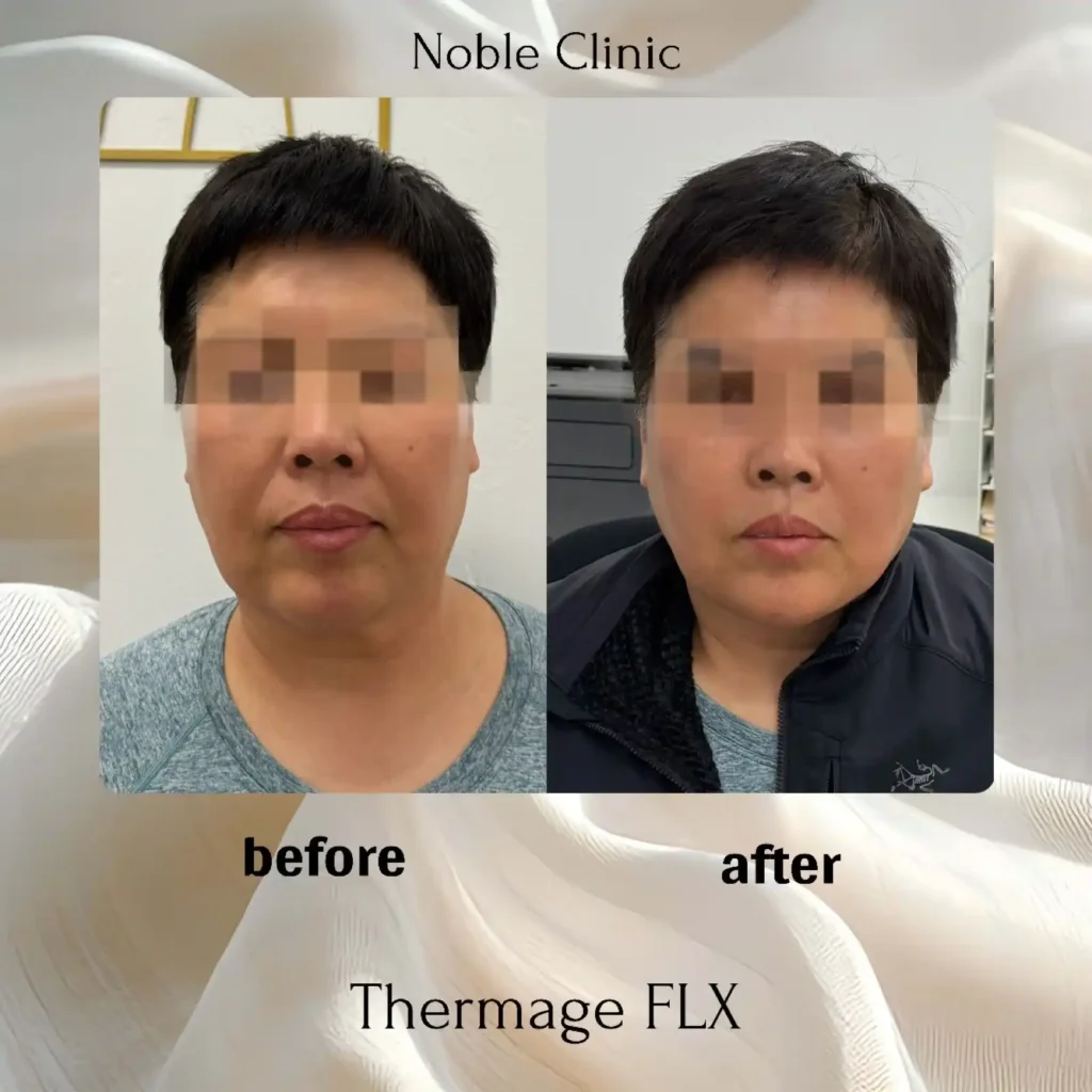 Thermage Before and After in Draper, Utah | Noble Clinic