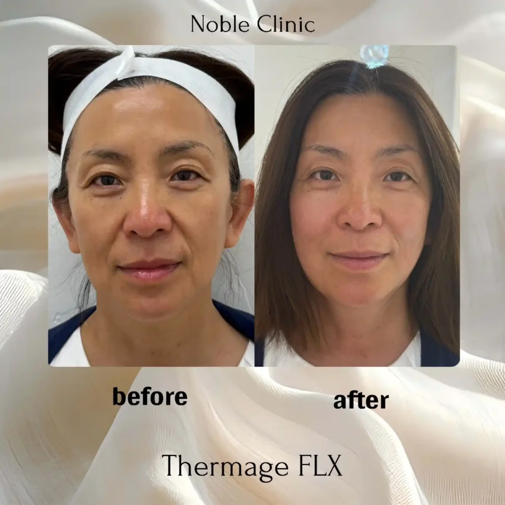 Thermage FLX Before and After in Draper, Utah | Noble Clinic