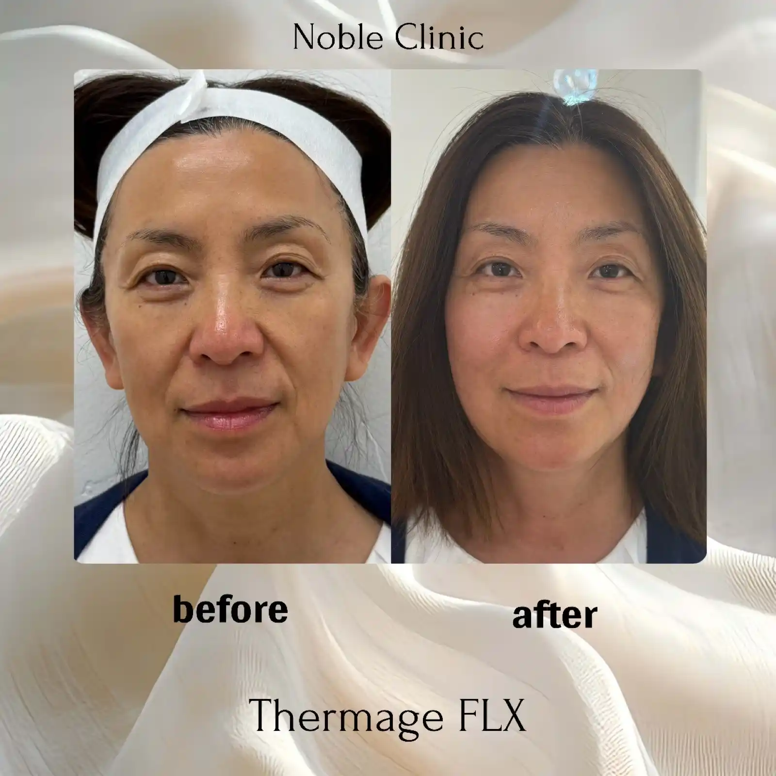 Thermage FLX Before and After in Draper, Utah | Noble Clinic