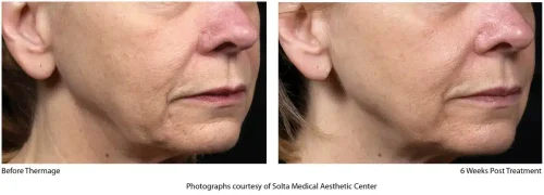Thermage-Before-After-SMAC_02_1655743923