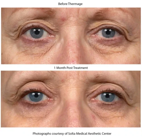 Thermage-Before-After-SMAC_05_1655743923