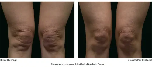 Thermage-Before-After-SMAC_06_1655743923