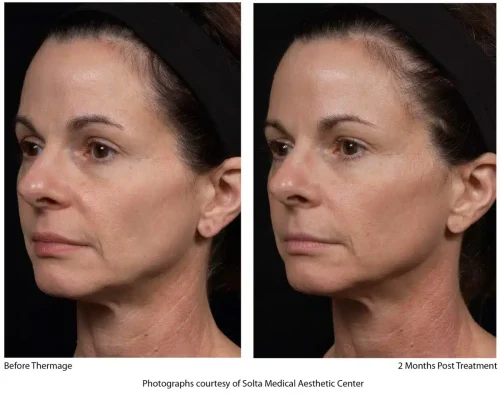 Thermage-Before-After-SMAC_07_1655743923