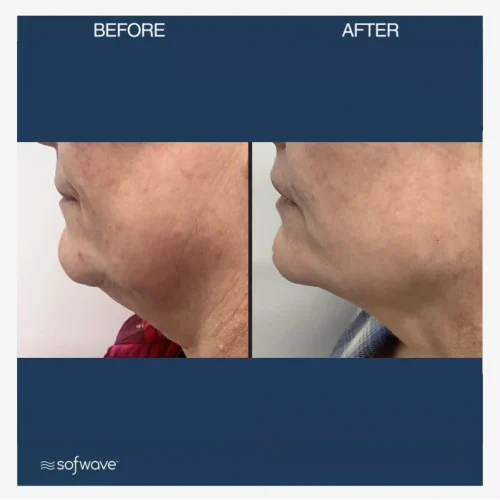 sofwave-thenobleclinic-before-and-after-bb