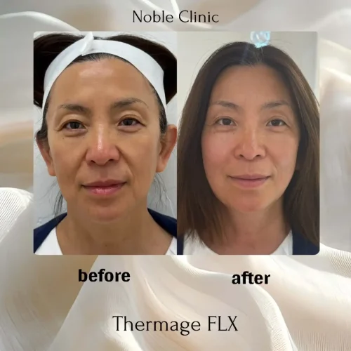 thermages-zon-noble-clinic-in-draper-ut